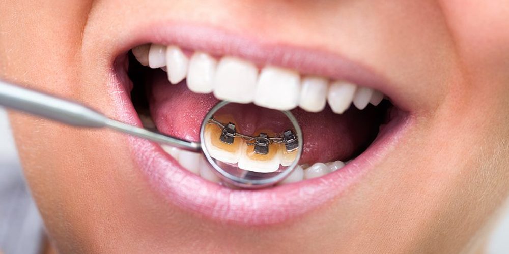 Avantages Et Inconvénients Du Métier D'orthodontiste