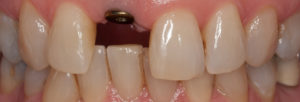implant dentaire,