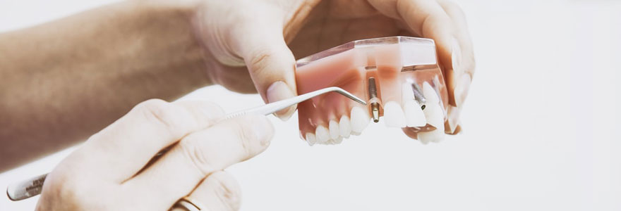 pourquoi se faire poser un implant dentaire en Turquie