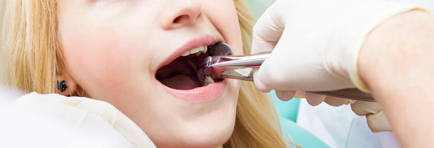 Extractions de dents