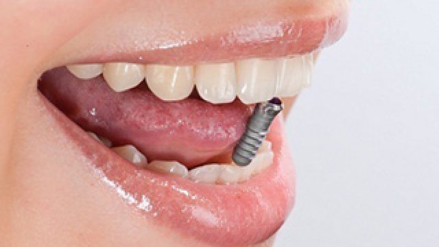 L’implantologie dentaire