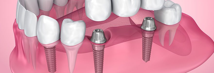 Prendre rendez-vous dans un centre dentaire à la défense pour la pose d&rsquo;implants