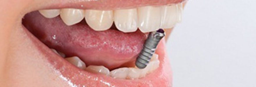 L’implantologie dentaire