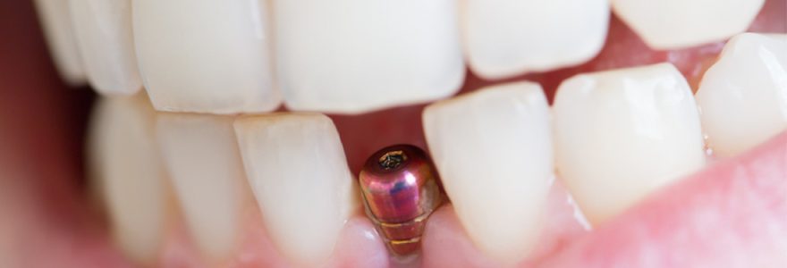 À quoi sert un implant dentaire ?