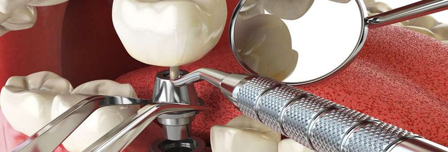 Quels sont les avantages de la pose d&rsquo;implant dentaire ?