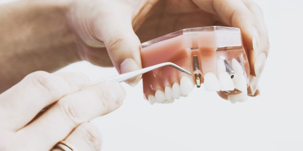 Pourquoi se faire poser un implant dentaire en Turquie ?