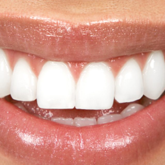 L&rsquo;implant dentaire, qu&rsquo;est-ce que c&rsquo;est ?
