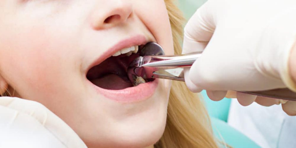 Extractions de dents au Luxembourg : guide pratique