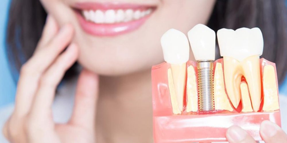 Les avantages de procéder à un implant dentaire