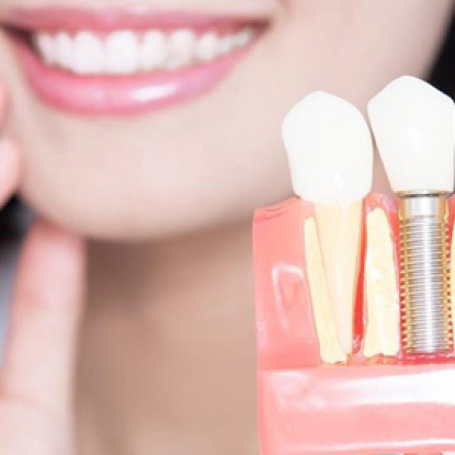 Les avantages de procéder à un implant dentaire