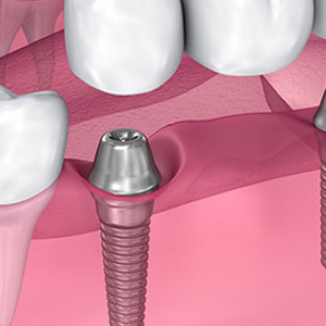 Prendre rendez-vous dans un centre dentaire à la défense pour la pose d&rsquo;implants