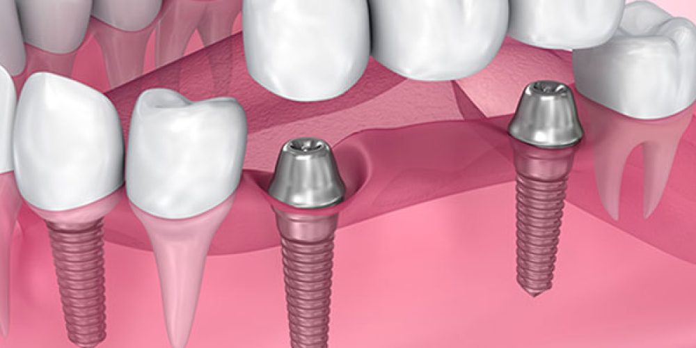 Prendre rendez-vous dans un centre dentaire à la défense pour la pose d’implants