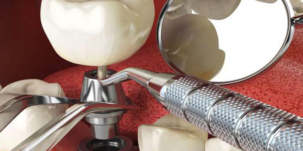 Quels sont les avantages de la pose d’implant dentaire ?
